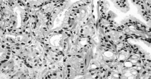 Muestra de cáncer de próstata